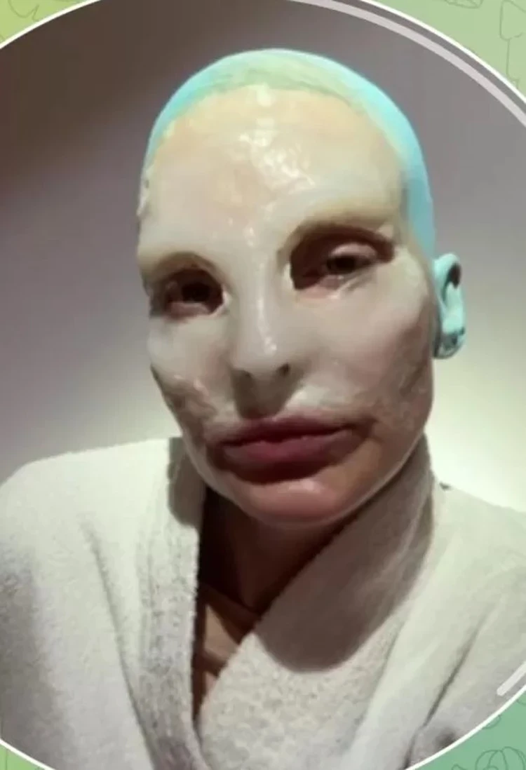 Лысая Глюкоза шокировала изменившимся лицом